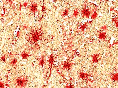 사진 설명 = 치매환자 뇌의 성상교세포(적색)에서 발현이 증가한 C8-감마 단백질(흑색) ⓒ석경호·류훈 교수 제공
